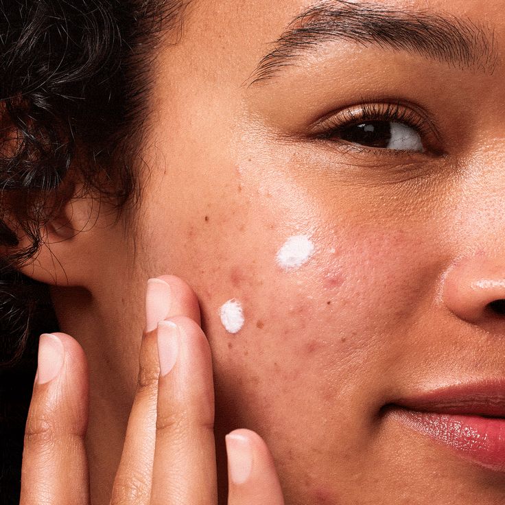 Order original Skin Concern Skincare Products in Nigeria | Acne, Dark Spots, Dry Skin | Rhema Beauty Shop in lagos Nigeria